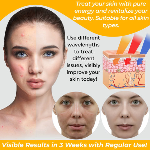 LED Face Mask - Light Therapy Mask - Acne Light Therapy